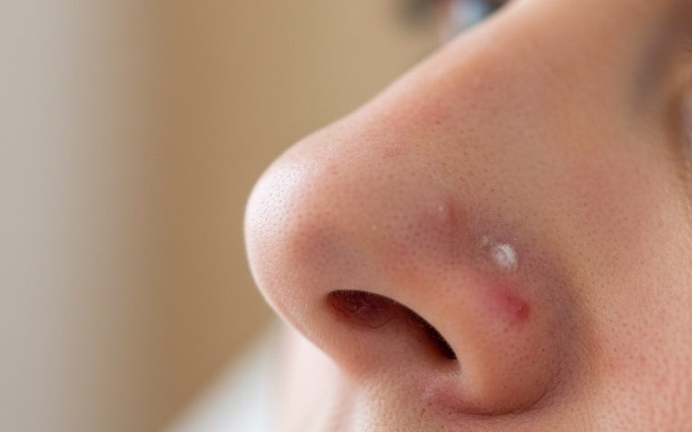 Gros plan sur un nez avec différents types de boutons cutanés visibles.